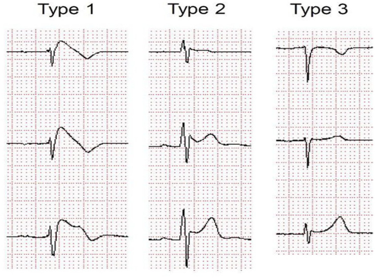 Brugada syndrome: should we be screening patients before prescribing psychotropic medication?