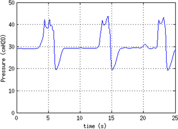 Robust, maintainable, emergency invasive mechanical ventilator.