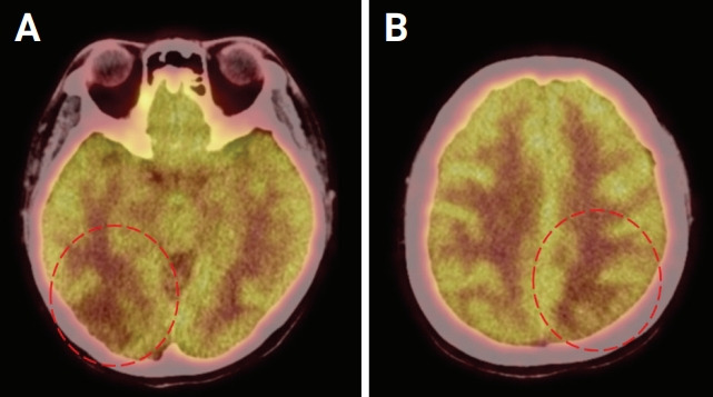 Successful treatment with rituximab for central nervous system vasculitis caused by Epstein-Barr virus-associated lymphoproliferative disorder with immunoglobulin M gammopathy.
