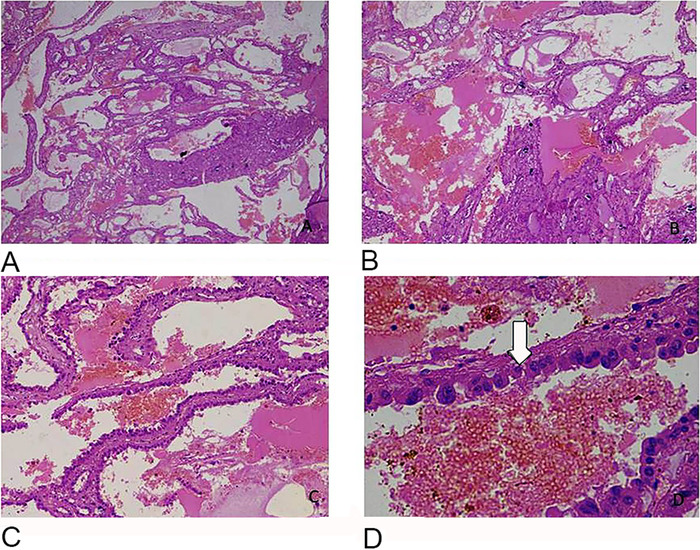 Tubulocystic Renal Cell Carcinoma: An Underrecognized Clinicopathologic Entity.