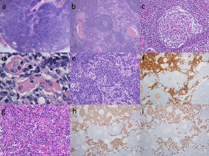 Castleman disease and mimickers: Clinicopathological findings of atypical lymphoproliferative disorders associated with autoimmune disease.