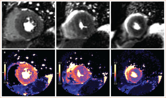 Imaging in Women with Heart Failure: Sex-specific Characteristics and Current Challenges.