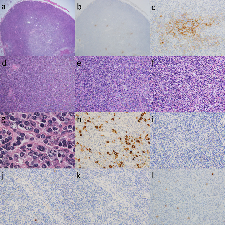 Castleman disease and mimickers: Clinicopathological findings of atypical lymphoproliferative disorders associated with autoimmune disease.