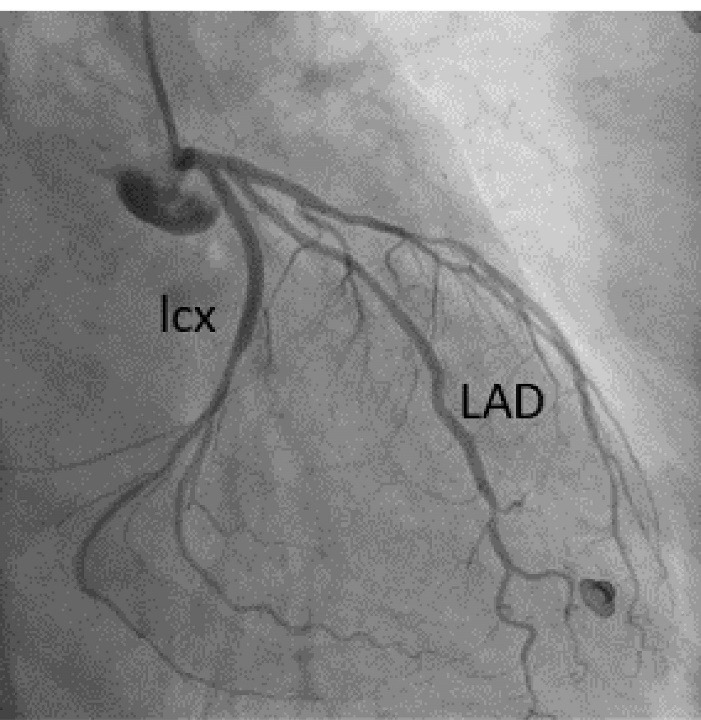 Left circumflex coronary artery injury following mitral valve replacement with late presentation: A case report and literature review.