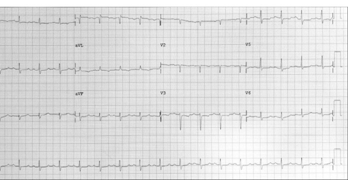 Left circumflex coronary artery injury following mitral valve replacement with late presentation: A case report and literature review.