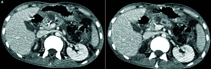 Disconnected Pancreatic Duct Syndrome: A Case Series.