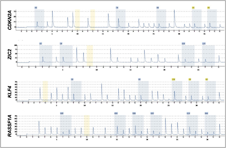 Methylation Profiling of Specific Genes in Ependymomas.