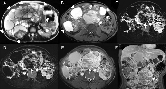 Tubulocystic Renal Cell Carcinoma: An Underrecognized Clinicopathologic Entity.
