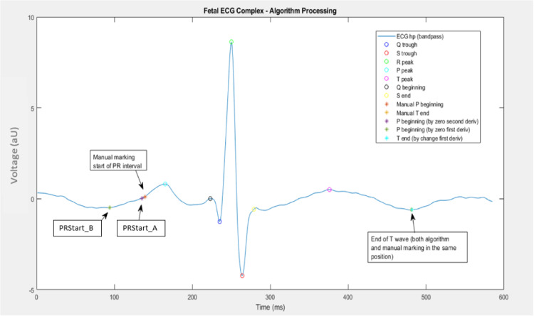 Measurement of the cardiac time intervals of the fetal ECG utilising a computerised algorithm: A retrospective observational study.