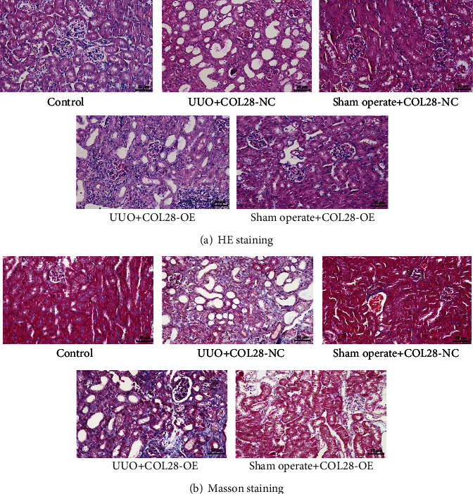 Type XXVIII Collagen Regulates Renal Interstitial Fibrosis and Epithelial-Mesenchymal Transition by SREBP1-Mediated HKDC1 Expression.