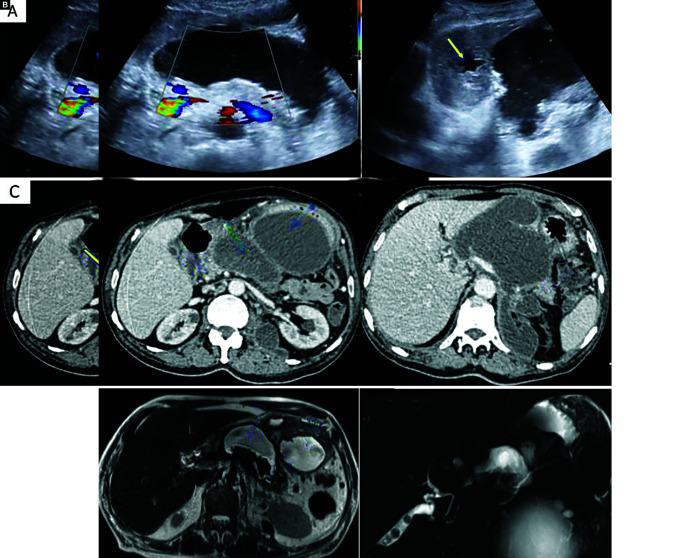 Disconnected Pancreatic Duct Syndrome: A Case Series.