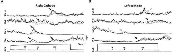 Effect of galvanic vestibular stimulation applied at the onset of stance on muscular activity and gait cycle duration in healthy individuals.