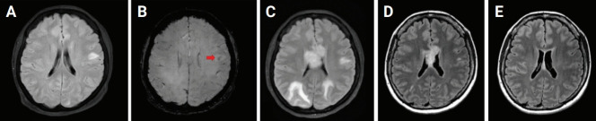 Successful treatment with rituximab for central nervous system vasculitis caused by Epstein-Barr virus-associated lymphoproliferative disorder with immunoglobulin M gammopathy.