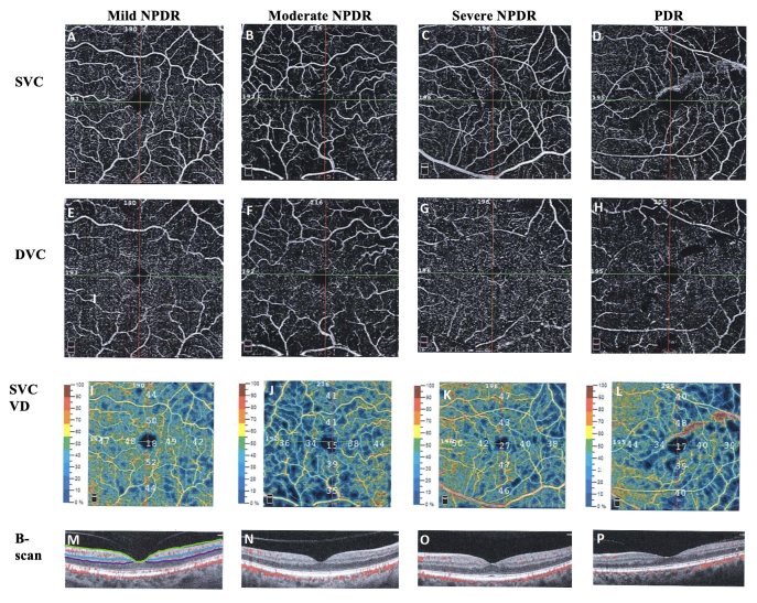 Using optical coherence tomography angiography as a biomarker of retinopathy severity and treatment for diabetic retinopathy.