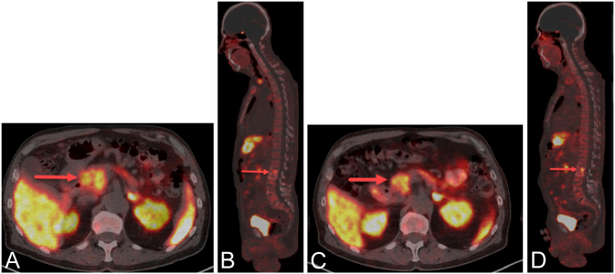 Synchronous AML and pancreatic neuroendocrine neoplasm, both successfully treated with somatostatin analogs and decitabine.