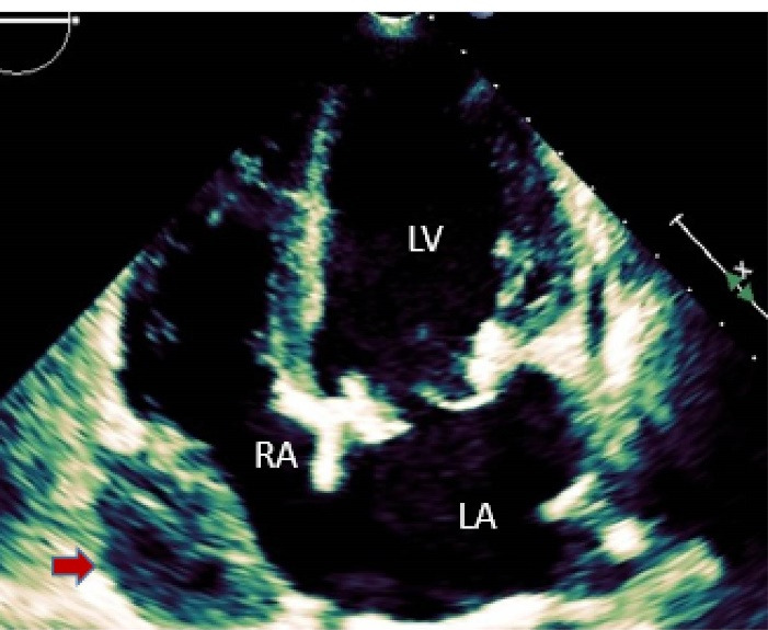 Left circumflex coronary artery injury following mitral valve replacement with late presentation: A case report and literature review.