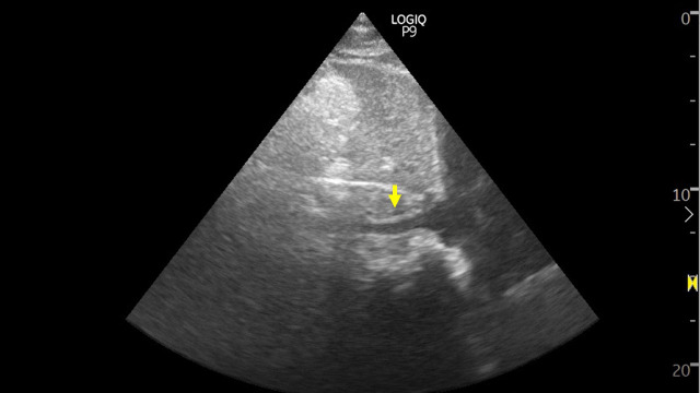 Utility of Nephrologist-Performed Point of Care Ultrasonography in the Evaluation of Hyponatremia.