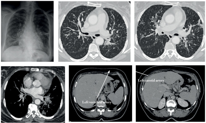 Unusual bone localization of sarcoidosis mimicking metastatic lesions: case report and review of literature.