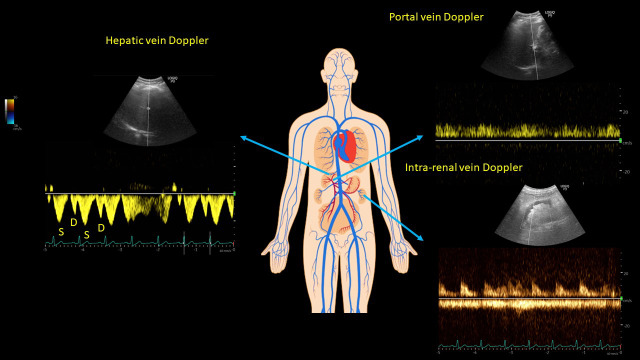 Utility of Nephrologist-Performed Point of Care Ultrasonography in the Evaluation of Hyponatremia.