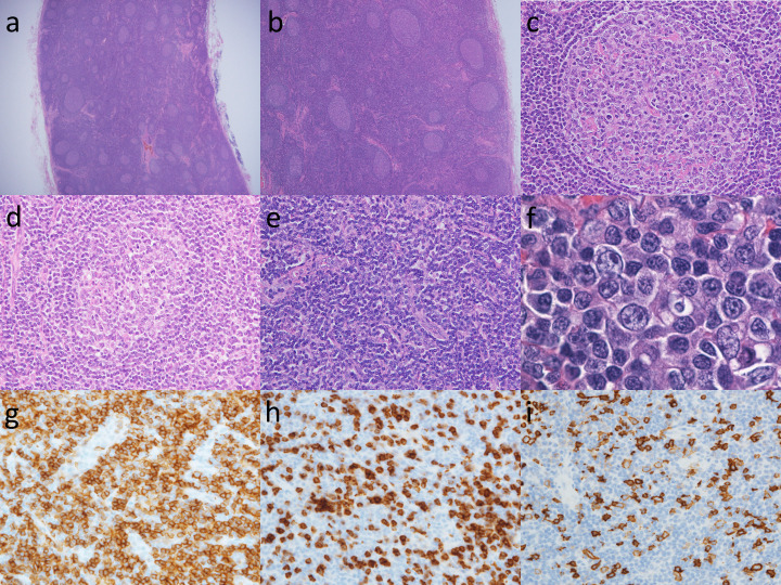 Castleman disease and mimickers: Clinicopathological findings of atypical lymphoproliferative disorders associated with autoimmune disease.