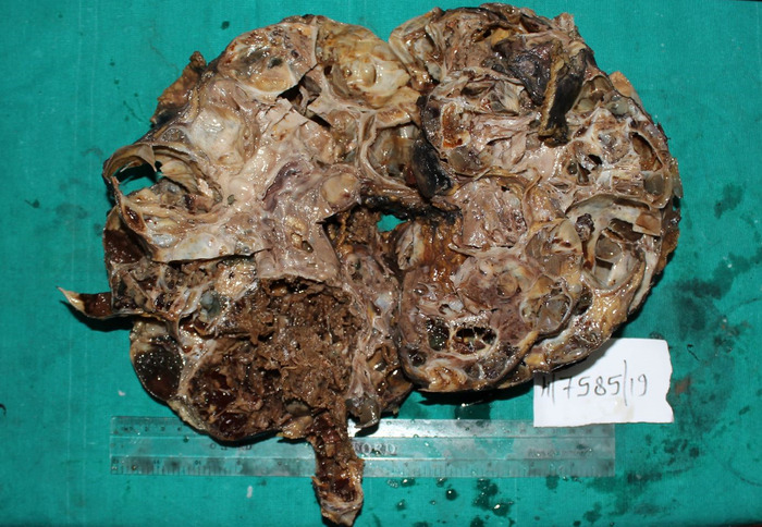 Tubulocystic Renal Cell Carcinoma: An Underrecognized Clinicopathologic Entity.