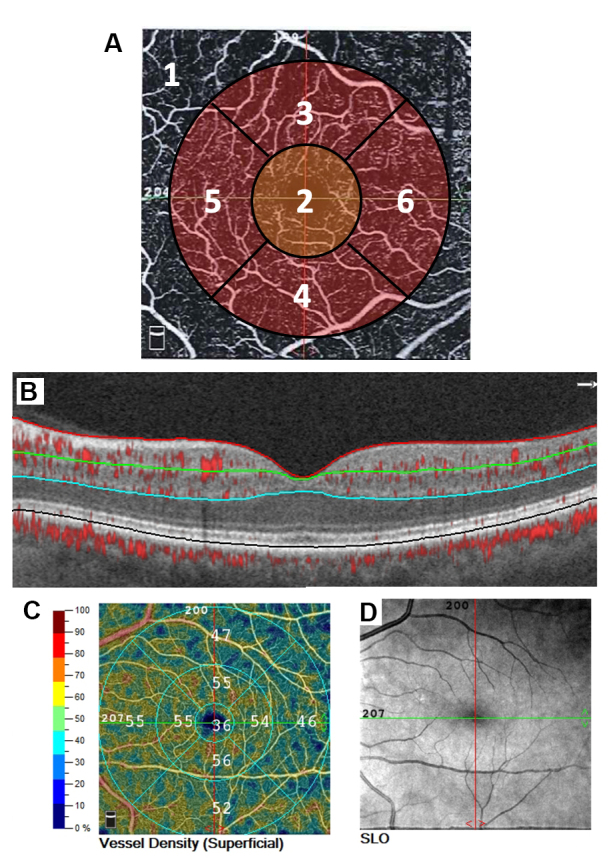 Using optical coherence tomography angiography as a biomarker of retinopathy severity and treatment for diabetic retinopathy.