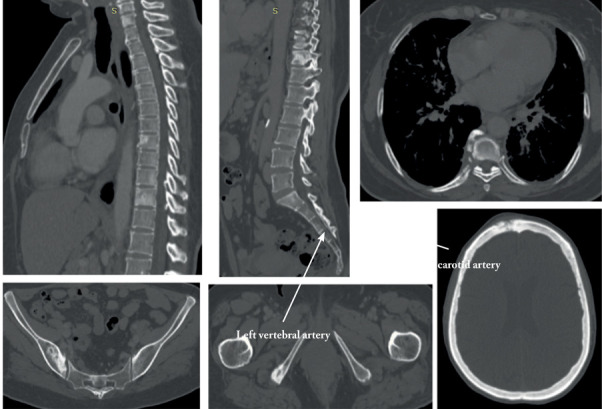 Unusual bone localization of sarcoidosis mimicking metastatic lesions: case report and review of literature.