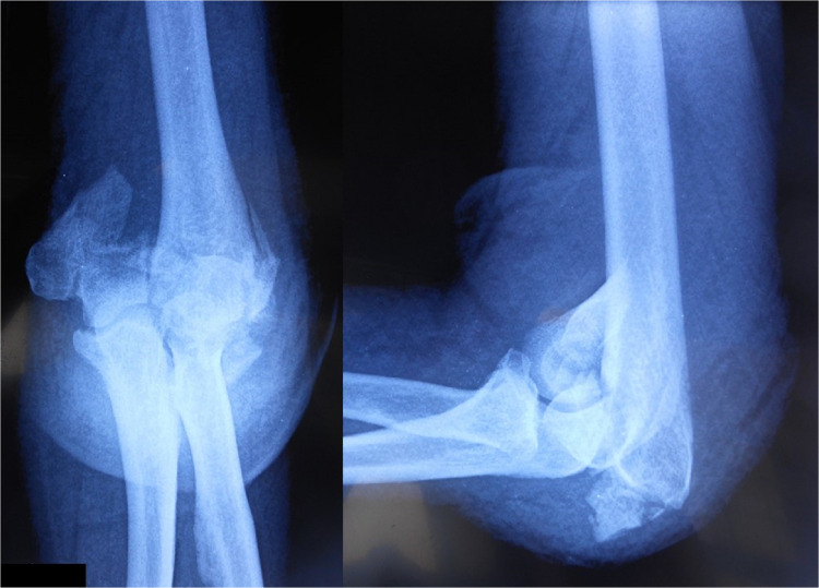 Total Elbow Arthroplasty and Antegrade Posterior Interosseous Flap for Infected Posttraumatic Arthritis with an Active Fistula. A Rationale for Comprehensive Treatment. Case Report.