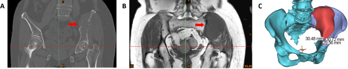 Three-dimensional-printed titanium prostheses with bone trabeculae enable mechanical-biological reconstruction after resection of bone tumours.