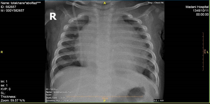 Upward spontaneous migration of ventriculoperitoneal shunt into the heart: A case report summary.