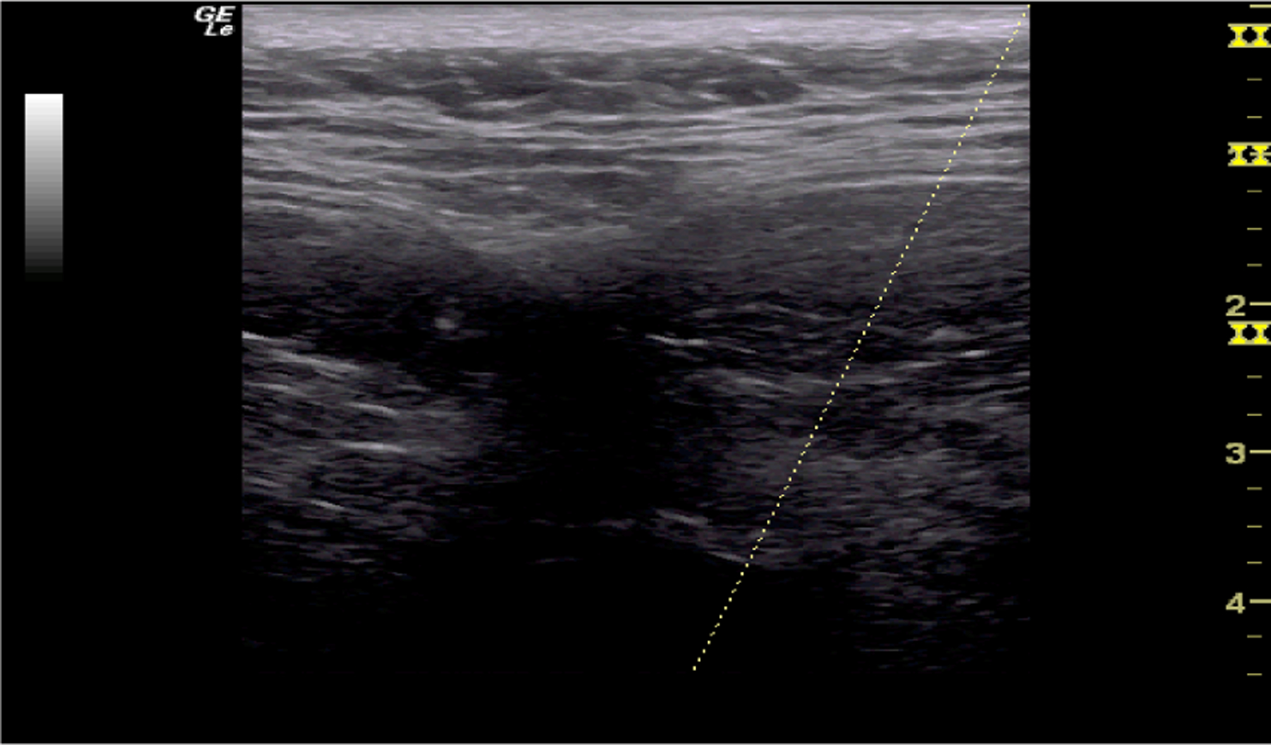 A New Minimally Invasive Procedure for Muscle, Back, Neck Pain and Radiculopathy - The Myofascial Nerve Block.