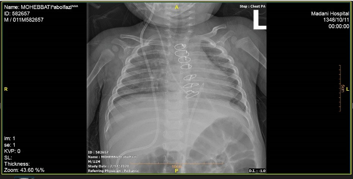 Upward spontaneous migration of ventriculoperitoneal shunt into the heart: A case report summary.