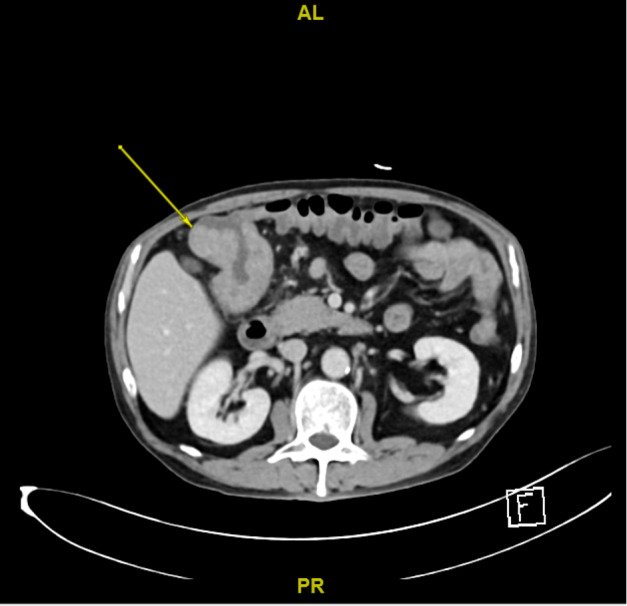 Point-of-Care Ultrasound for the Diagnosis of Colon Cancer.