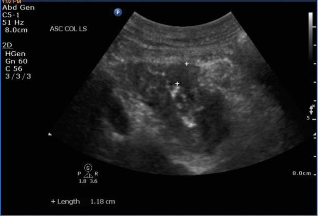 Point-of-Care Ultrasound for the Diagnosis of Colon Cancer.