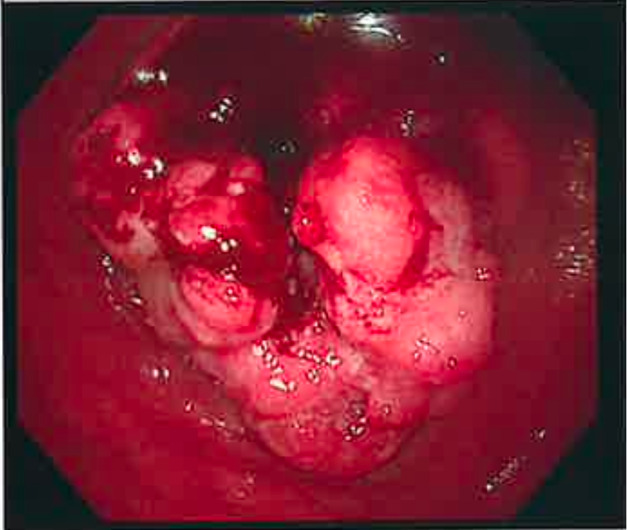 Point-of-Care Ultrasound for the Diagnosis of Colon Cancer.