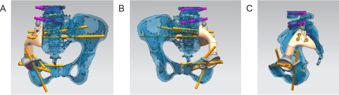 Three-dimensional-printed titanium prostheses with bone trabeculae enable mechanical-biological reconstruction after resection of bone tumours.