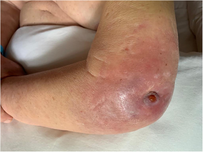 Total Elbow Arthroplasty and Antegrade Posterior Interosseous Flap for Infected Posttraumatic Arthritis with an Active Fistula. A Rationale for Comprehensive Treatment. Case Report.