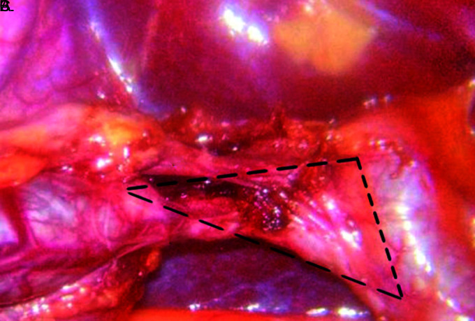 Strasberg's Critical View: Strategy for a Safe Laparoscopic Cholecystectomy.