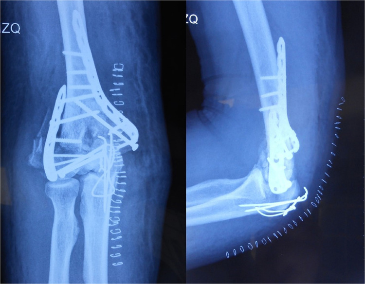 Total Elbow Arthroplasty and Antegrade Posterior Interosseous Flap for Infected Posttraumatic Arthritis with an Active Fistula. A Rationale for Comprehensive Treatment. Case Report.