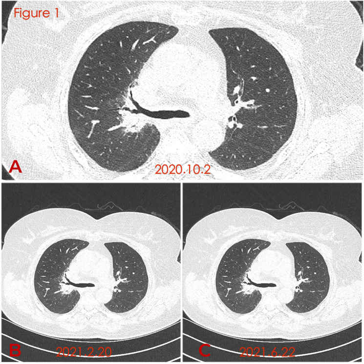 Small cell lung cancer with relapsing polychondritis: A report of one case and the review of literature.