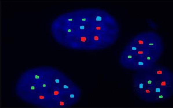 Clonal heterogeneity by fluorescence in situ hybridization in multiple myeloma: enhanced cytogenetic risk stratification.