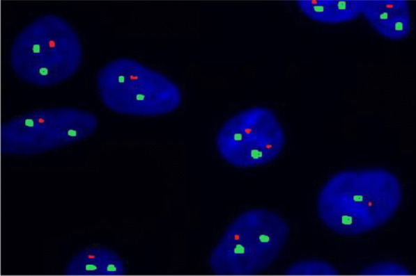 Clonal heterogeneity by fluorescence in situ hybridization in multiple myeloma: enhanced cytogenetic risk stratification.