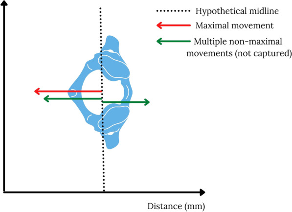 Maximum movement and cumulative movement (travel) to inform our understanding of secondary spinal cord injury and its application to collar use in self-extrication.