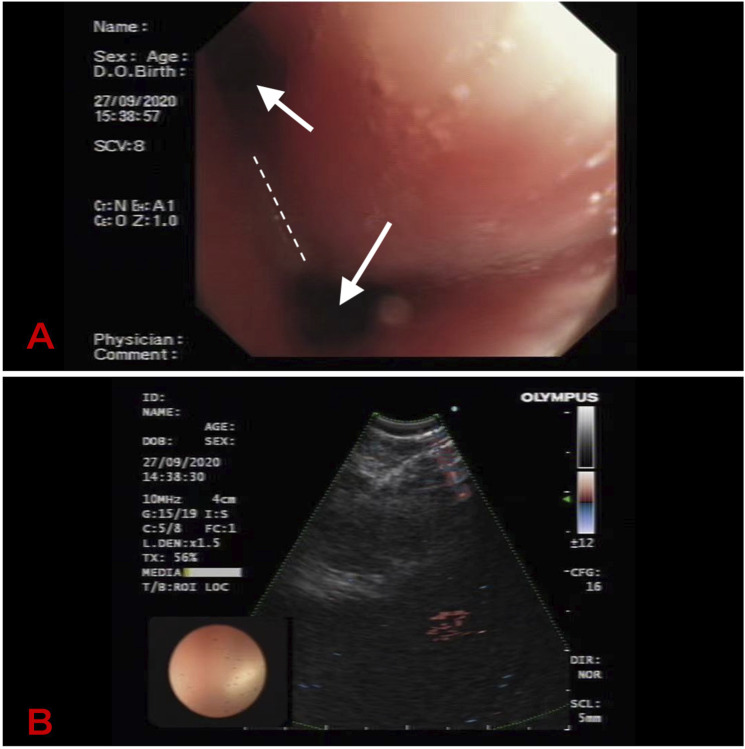 Small cell lung cancer with relapsing polychondritis: A report of one case and the review of literature.