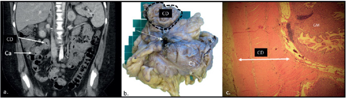 Caecal Diverticulum Causing Catastrophic Gastrointestinal Bleeding in a Child: A Case Report.