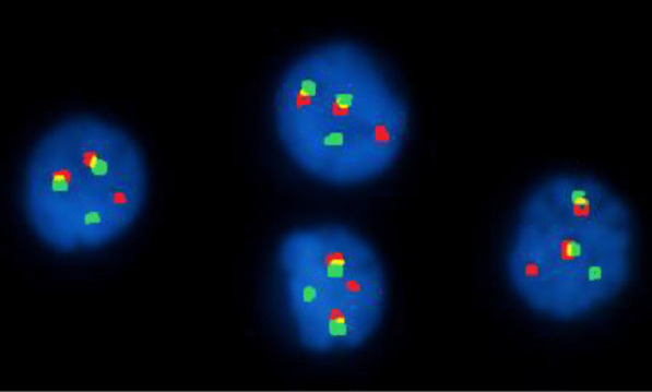 Clonal heterogeneity by fluorescence in situ hybridization in multiple myeloma: enhanced cytogenetic risk stratification.