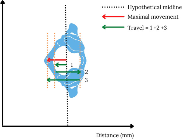 Maximum movement and cumulative movement (travel) to inform our understanding of secondary spinal cord injury and its application to collar use in self-extrication.