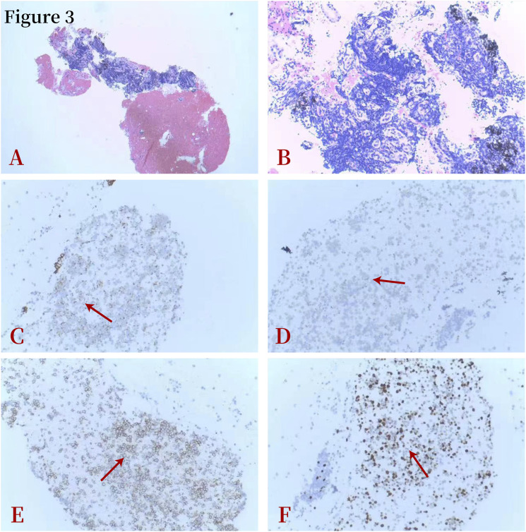 Small cell lung cancer with relapsing polychondritis: A report of one case and the review of literature.