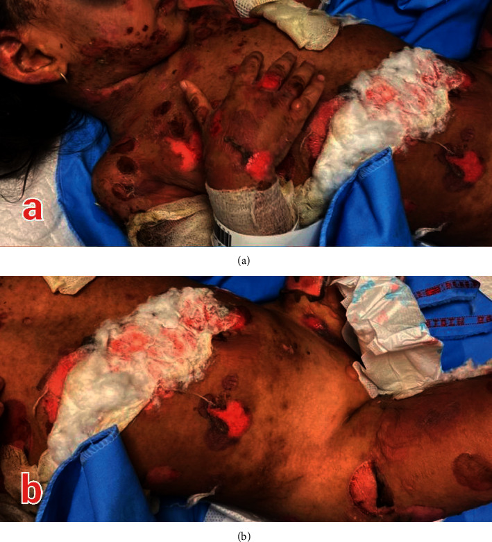 An Unusual TEN-Like Presentation of Juvenile Bullous Pemphigoid: A Diagnostic Challenge.