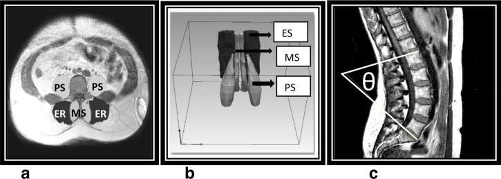 The impact of altering participant MRI scanning position on back muscle volume measurements.